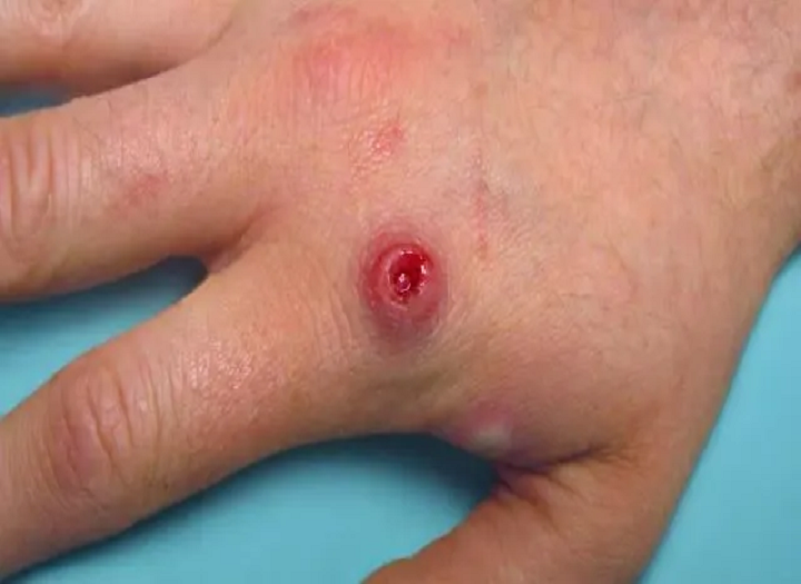 Разбирање на monkeypox и како да се спречи тоа